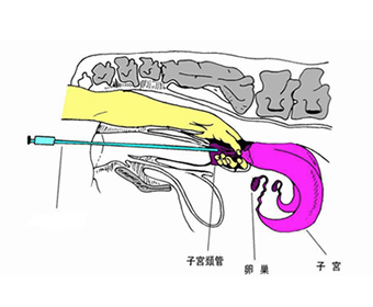 採取胚前の準備